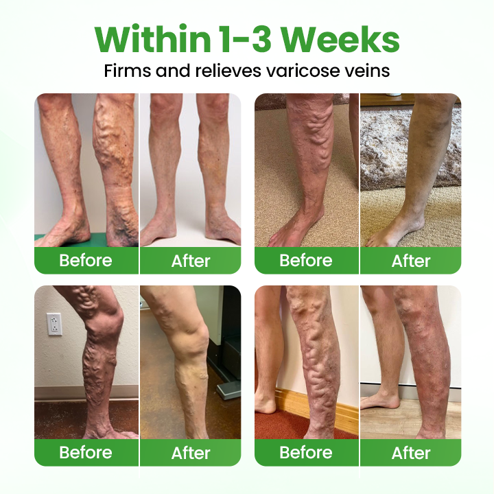 Pryxo® VeinHeal Microneedle Patch