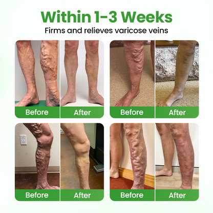 Pryxo® VeinHeal Microneedle Patch