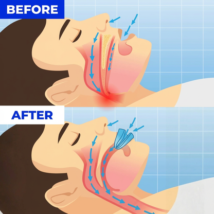 Pryxo™ Professional anti-snoring device