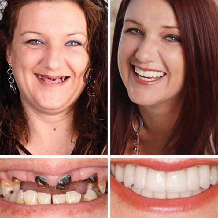 🌎Ends Today: 70% OFF! ⏰ Custom-Fit Full Functional Dentures Make you more confident